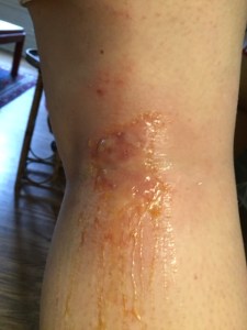 Poison ivy. Disgusting.